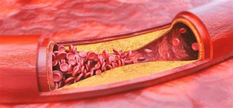 atherosclerotic aorta in tagalog|Mga Sintomas Ng Atherosclerosis Na Dapat Bantayan.